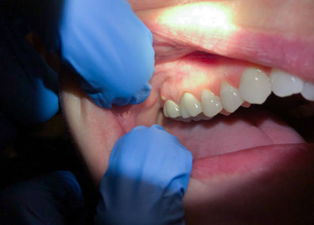 Best Emergency Gum Treatment in Clinton, LA